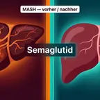 Infografik zu Semaglutid-Wirkung auf Lebergewebe bei MASH und Fibrose